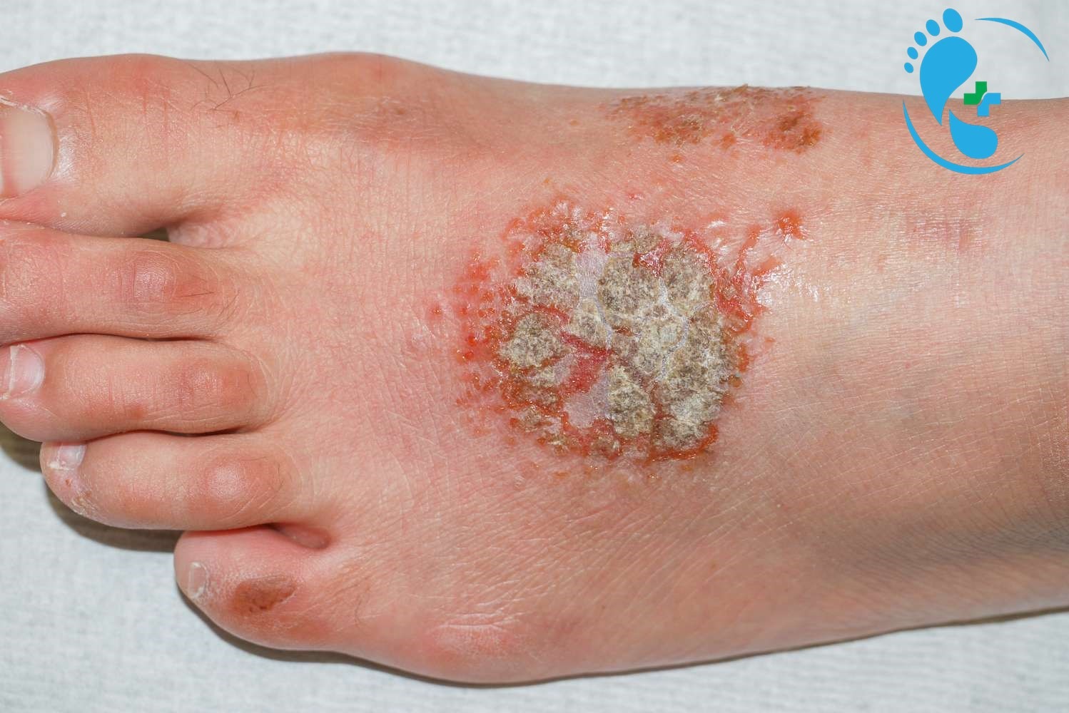 التهاب زخم و ترشح چرکی پا چیست؟