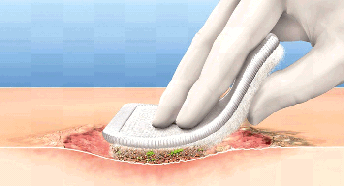 استفاده از پانسمان برای درمان قطعی زخم پای دیابتی