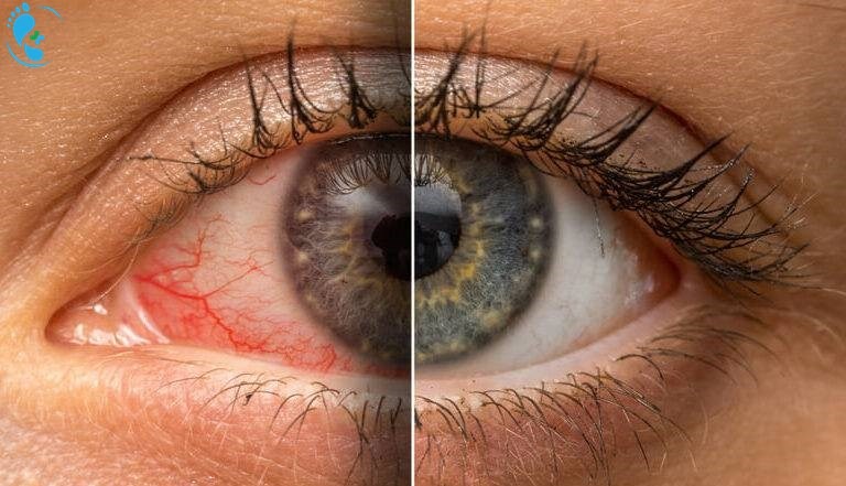 عوارض استفاده از پماد تتراسایکلین چشمی