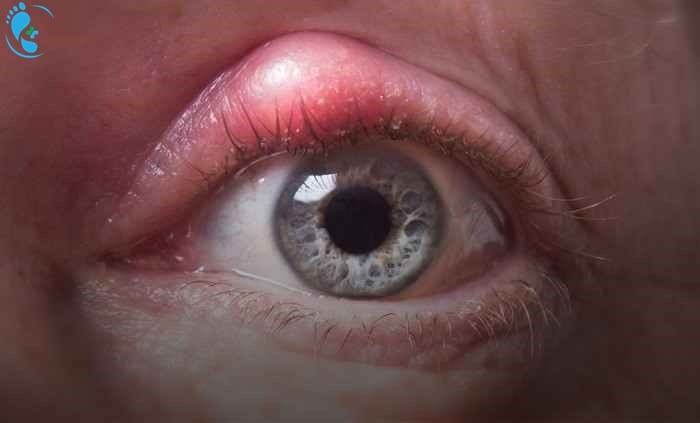 موارد مصرف پماد چشمی تتراسایکلین